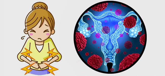 cervical cancer and lupus