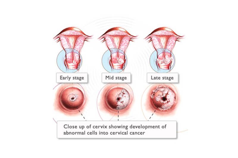 Type of cervical cancer
