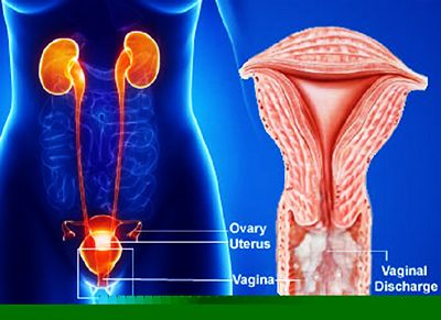 cervical cancer discharge