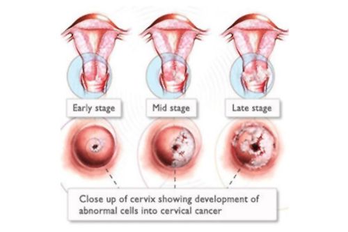 Cryogenic Treatment for cervical cancer