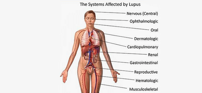 lupus as autoimmune desease