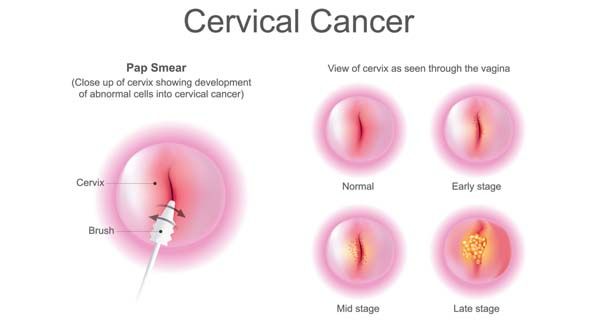 The Best Time To Take The Pap Test Is NOW