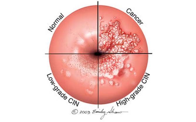 cervical cancer Human Papilloma Virus